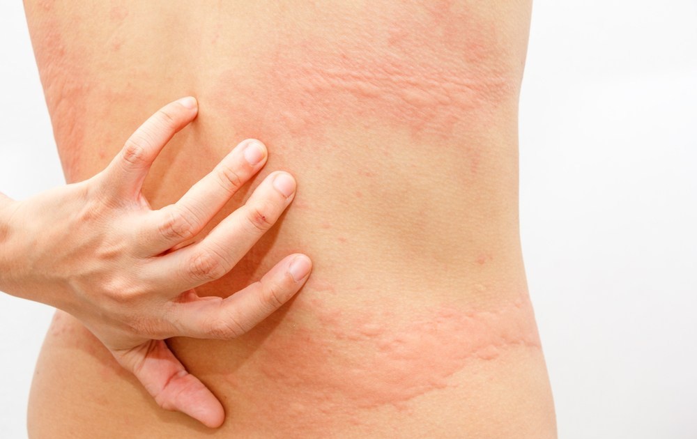 Mẹo Làm Khô Quần Áo Nhanh Trong Những Ngày Mưa Lâu Ngày 3 Quần áo ẩm có thể gây phát ban trên da